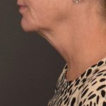 Neck Lift Before & After Patient #4268