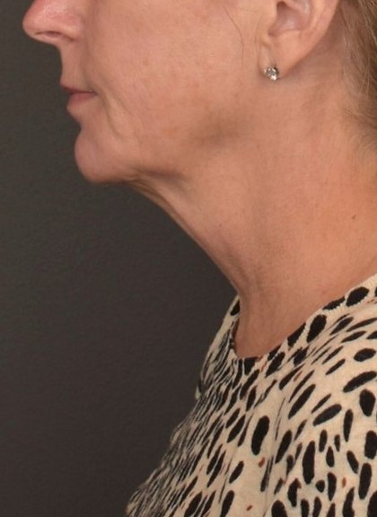 Neck Lift Before & After Patient #4268