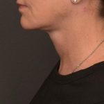 Neck Lift Before & After Patient #4268
