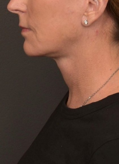 Neck Lift Before & After Patient #4268