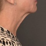 Neck Lift Before & After Patient #4268