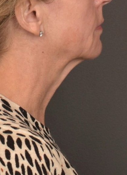 Neck Lift Before & After Patient #4268