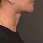 Neck Lift Before & After Patient #4268