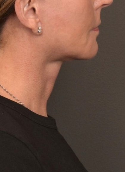 Neck Lift Before & After Patient #4268