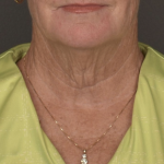 Facelift Before & After Patient #4258