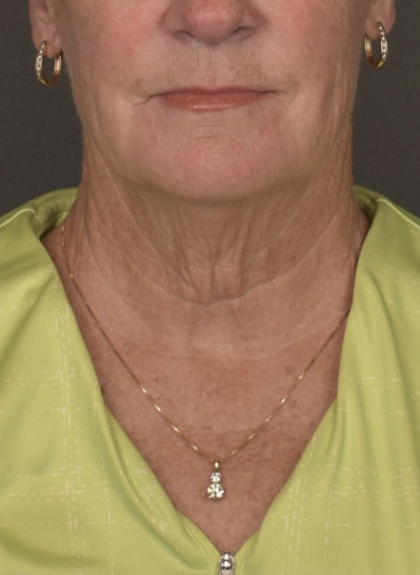 Facelift Before & After Patient #4258