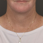Facelift Before & After Patient #4258