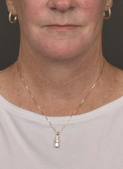 Facelift Before & After Patient #4258