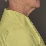 Facelift Before & After Patient #4258