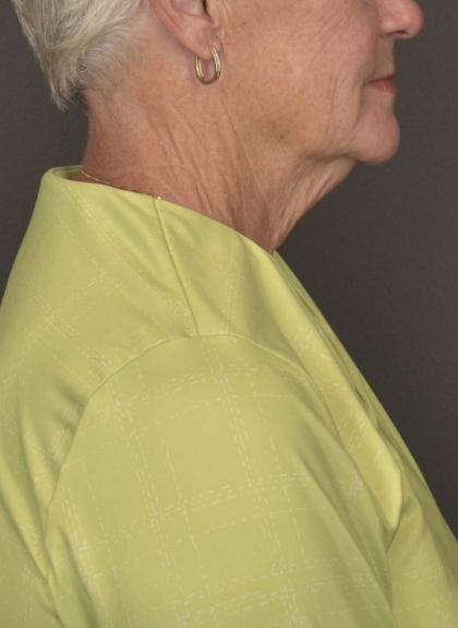Facelift Before & After Patient #4258