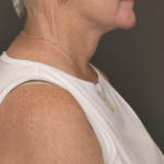 Facelift Before & After Patient #4258