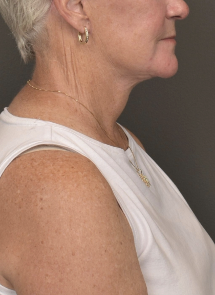 Facelift Before & After Patient #4258