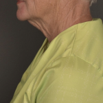 Facelift Before & After Patient #4258