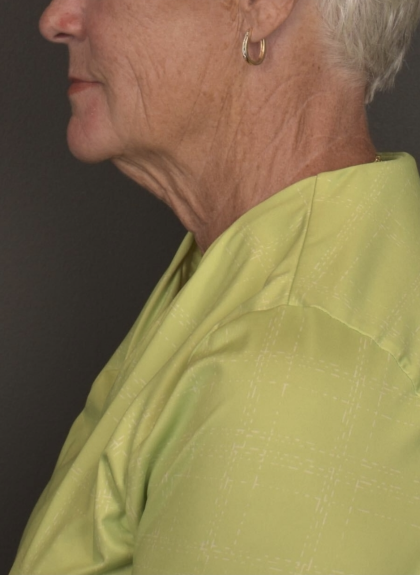Facelift Before & After Patient #4258