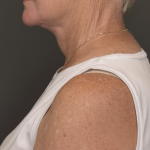 Facelift Before & After Patient #4258
