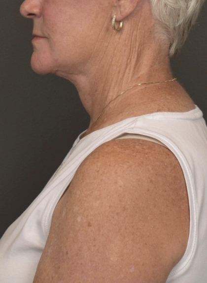 Facelift Before & After Patient #4258